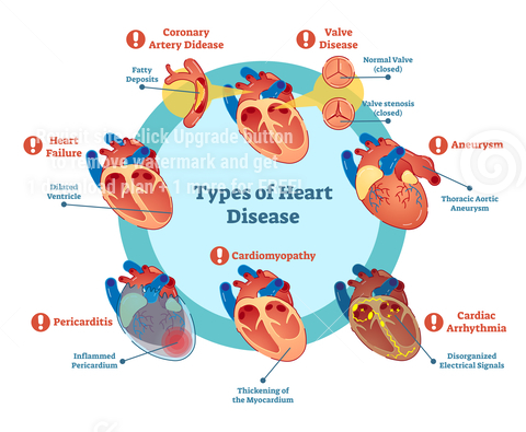 illustration of different types of cardiovascular disease
